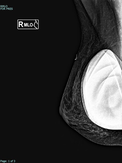 Correlative tomosynthesis, sonographic, and histopathological findings in a 45-year-old woman presenting with a palpable right breast lump. Synthesized 2D mammogram, right breast, mediolateral oblique (MLO) projection. No discrete abnormality is visualized due to extremely dense parenchyma (BI-RADS category D). A retroglandular silicone breast implant is in situ.