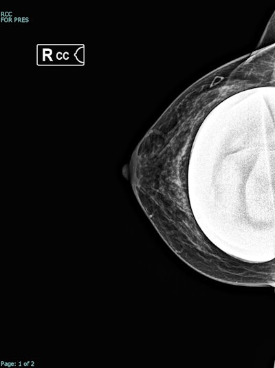 Synthesized 2D mammogram, right breast, craniocaudal (CC) projection of the same patient. No mammographic abnormality is seen. Sensitivity is markedly reduced by dense breast tissue. A retroglandular silicone breast implant is present.