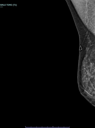 3D breast tomosynthesis, right breast, MLO push-back view of the same patient. Localized increased stromal density corresponding to the clinically palpable lump, more evident compared with routine 2D projections.