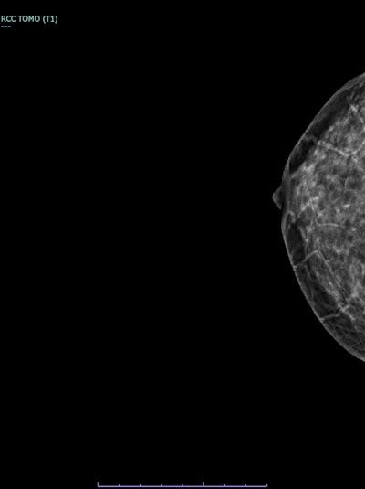 3D breast tomosynthesis, right breast, CC push-back view of the same patient. No definite abnormality demonstrated due to extremely dense breast parenchyma, underscoring the masking effect of density.