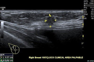 Whole breast ultrasound (selected image), right breast, 10 o’clock position, same patient. An 8 mm irregular isoechoic solid lesion with microlobulated margin, ductal extension, and adjacent fat plane distortion. The lesion is sonographically suspicious and correlates with the palpable abnormality and tomosynthesis findings. A retroglandular silicone breast implant is noted, intact. Biopsy confirmed invasive ductal carcinoma, Grade 1, ER positive, PR positive, HER2 equivocal (2+). Low-grade ductal carcinoma in situ with solid architecture was also identified. Findings are consistent with invasive ductal carcinoma in an extremely dense breast. The patient was referred for surgical management.