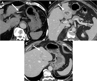 A 74-year-old man underwent a contrast-enhanced CT for colonic adenocarcinoma extension assessment (A). A fishbone was found, which was located purely into the omental bursa. There was no sign of gastric perforation (no pneumoperitoneum and no gastric abnormality) but there was discrete fat stranding around the fishbone with no collection (the patient was asymptomatic). Two and a half months later the patient presented with significant change in his general condition with an inflammatory syndrome alongside nausea. He presented to the emergency department and a contrast-enhanced CT was performed (B). In the portal venous phase, the fishbone had migrated into the left liver lobe forming an abscess of 5 cm (maximal diameter). The patient had a C-reactive protein (CRP) level of 164 mg/l and a WBC of 14 G/L. The patient received antibiotic treatment and percutaneous drainage. On follow up imaging (C), 10 months later, the remaining fishbone was present but the liver abscess has completely disappeared.