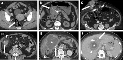 Various case examples of fishbone localization and related complications. (A) A fishbone (arrow) is visualized within the lumen of the rectum. The patient was asymptomatic, and no bowel wall thickening or adjacent fat stranding was observed, therefore this patient was excluded from analysis. (B) A fishbone (arrow) is impacted in the antral wall of the stomach, with no perforation but mild thickening of the antral wall (arrowhead). The patient presented with abdominal pain and inflammatory syndrome. (C) A fishbone (arrow) perforates the ileum, localised within an abdominal wall hernia (arrowheads). A fluid collection is forming at the site of perforation. (D) A fishbone (arrow) perforates the right colon, without pneumoperitoneum. Only epiploic fat stranding is seen (arrowhead). (E) A large epiploic fluid collection (star) is seen fistulizing into the abdominal wall (arrowhead). A fishbone (arrow) is visualized within the transverse colon. (F) The patient presented with a right liver lobe abscess (star) with hypodense infiltration (arrowhead) surrounding the collection and extending towards the hepatic hilum. A small linear foreign body, consistent with a fishbone (arrow), is seen within the liver.