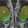 Example of prostate zonal segmentation by the AI software in a patient. Yellow: transition zone; green: peripheral zone; red, anterior fibromuscular stroma; blue, central zone.