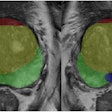 Example of prostate zonal segmentation by the AI software in a patient. Yellow: transition zone; green: peripheral zone; red, anterior fibromuscular stroma; blue, central zone.