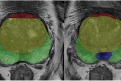 Example of prostate zonal segmentation by the AI software in a patient. Yellow: transition zone; green: peripheral zone; red, anterior fibromuscular stroma; blue, central zone.