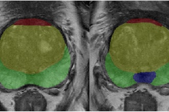 Example of prostate zonal segmentation by the AI software in a patient. Yellow: transition zone; green: peripheral zone; red, anterior fibromuscular stroma; blue, central zone.