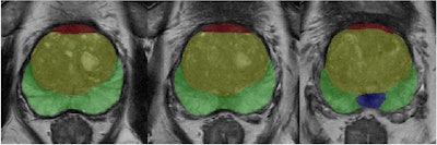 Example of prostate zonal segmentation by the AI software in a patient. Yellow = transition zone; green = peripheral zone; red = anterior fibromuscular stroma; and blue = central zone.