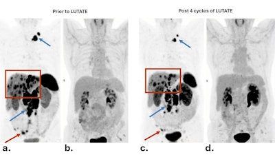 Dual PET imaging in Case One shows a patient with a diagnosis of metastatic midgut neuroendocrine tumor. Baseline DOTATATE PET (a) in 2016 shows intense uptake in small bowel primary (red arrows), peritoneal, lymph node (blue arrows) and liver metastases (red boxes). Paired FDG PET (b) in 2016 showed no significant FDG uptake in DOTATATE avid lesions, and no discordant lesions, consistent with a NETPET score of 1. This patient subsequently received 4 cycles of Lutate, with sustained and durable response. Dual PET imaging in 2021 (c, d) showed ongoing response to treatment with stable disease and no new FDG avid lesions. All figures courtesy of Dr. Claire Mok et al and Department of Nuclear Medicine, Royal North Shore Hospital, Sydney, presented at RANZCR 2025.