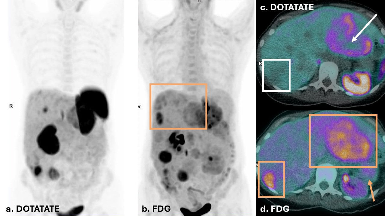 Dual PET imaging in Case Two illustrates a patient with discordant disease. FDG PET (b & d) shows FDG uptake in tail of pancreas primary lesion (yellow arrow), as well as multiple hepatic metastases (yellow boxes), with enlarged liver span. DOTATATE PET on left (a) shows several hepatic metastases that do not demonstrate DOTATATE uptake above background of liver parenchyma. The liver lesions in (c) demonstrate moderate FDG uptake in liver lesions, with no corresponding DOTATATE avidity (white box) or central photopenia (white arrow). This discordance in dual PET imaging corresponds to a NETPET score of 5. This suggests de-differentiated disease and a less favorable prognosis. The patient was not suitable for LUTATE treatment and received chemotherapy.
