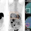 Dual PET imaging in Case Two illustrates a patient with discordant disease. FDG PET (b & d) shows FDG uptake in tail of pancreas primary lesion (yellow arrow), as well as multiple hepatic metastases (yellow boxes), with enlarged liver span. DOTATATE PET on left (a) shows several hepatic metastases that do not demonstrate DOTATATE uptake above background of liver parenchyma. The liver lesions in (c) demonstrate moderate FDG uptake in liver lesions, with no corresponding DOTATATE avidity (white box) or central photopenia (white arrow). This discordance in dual PET imaging corresponds to a NETPET score of 5. This suggests de-differentiated disease and a less favorable prognosis. The patient was not suitable for LUTATE treatment and received chemotherapy.