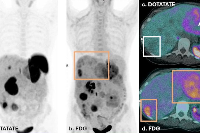 Dual PET imaging in Case Two illustrates a patient with discordant disease. FDG PET (b & d) shows FDG uptake in tail of pancreas primary lesion (yellow arrow), as well as multiple hepatic metastases (yellow boxes), with enlarged liver span. DOTATATE PET on left (a) shows several hepatic metastases that do not demonstrate DOTATATE uptake above background of liver parenchyma. The liver lesions in (c) demonstrate moderate FDG uptake in liver lesions, with no corresponding DOTATATE avidity (white box) or central photopenia (white arrow). This discordance in dual PET imaging corresponds to a NETPET score of 5. This suggests de-differentiated disease and a less favorable prognosis. The patient was not suitable for Lutate treatment and received chemotherapy.