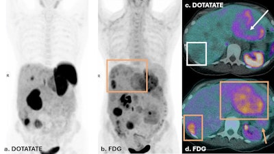 Dual PET imaging in Case Two illustrates a patient with discordant disease. FDG PET (b & d) shows FDG uptake in tail of pancreas primary lesion (yellow arrow), as well as multiple hepatic metastases (yellow boxes), with enlarged liver span. DOTATATE PET on left (a) shows several hepatic metastases that do not demonstrate DOTATATE uptake above background of liver parenchyma. The liver lesions in (c) demonstrate moderate FDG uptake in liver lesions, with no corresponding DOTATATE avidity (white box) or central photopenia (white arrow). This discordance in dual PET imaging corresponds to a NETPET score of 5. This suggests de-differentiated disease and a less favorable prognosis. The patient was not suitable for Lutate treatment and received chemotherapy.