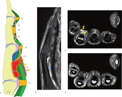 Indirect signs of A2 pulley rupture on MRI.(a) Schematic illustration. (b) Sagittal and (c) axial proton density fat-saturated (PD FS) MRI. (d) Axial T1-weighted MRI. Findings include increased tendon-to-bone distance (double-headed blue arrow), fluid effusion within the tendon sheath (yellow arrow), deep fluid collection surrounding the tendons (asterisk), and perilesional edema superficial to the tendon (orange arrow). On the axial PD FS (c) and T1-weighted (d) images, direct visualization of the A2 pulley rupture is limited, but tendon-to-bone separation is clearly visible on both sagittal and axial views (double-headed blue arrow).