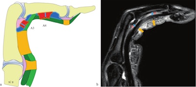 Finger in flexion against resistance. Combined complete rupture of the A3 and A4 pulleys. (a) Schematic illustration. (b) Sagittal proton density fat-saturated (PD FS) MRI. Fluid effusion (asterisk) and increased distance between the flexor tendon and the volar plate at the level of the joint (double-headed blue arrow) confirm injury to the A3 pulley. Fluid effusion (asterisk) and separation between the middle phalanx (P2) and the tendon (double-headed blue arrow) indicate additional injury to the A4 pulley. Note the edematous infiltration of the A3 and A4 pulleys located superficial to the flexor tendons (orange arrows).