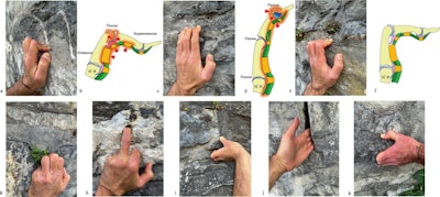 Finger positions used by climbers. Crimping position (a, b): The DIP joint is hyperextended, the PIP joint is flexed, the MCP joint is extended, and the wrist is extended. This position places high stress on the cartilage and pulley system. Suspended or extended position (c, d): The PIP, DIP, and MCP joints are flexed, while the wrist may be flexed, neutral, or extended. This position increases stress on the tendons, joint capsule, and ligaments. Semi-arched position (e, f): Increasingly recommended because it reduces mechanical stress. Stacked finger position (g): In this grip, shear stress is exerted on the MCP and PIP joints as well as on the connexus intertendineus of the extensor tendons. Single-finger grip (h): The DIP joint is flexed, the other joints are extended, and the MCP joints of the adjacent fingers are maximally flexed, increasing the tensile load on the “active” finger through the quadriga effect. Underhand grip (i). Lock or jam (j): This grip involves sliding the fingers into a crack. Pincer grip (k): In this grip, the thumb acts as an opponent while the long fingers adopt a semi-arched position. DIP, distal interphalangeal joint; PIP, proximal interphalangeal joint; MCP, metacarpophalangeal joint.