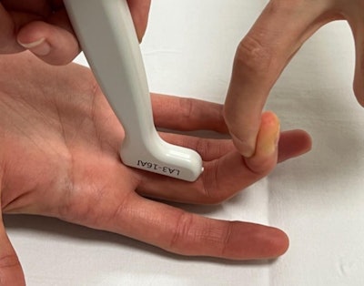 Ultrasound examination using the counter-flexion technique. To assess for rupture of the A2 pulley, the probe is positioned over the proximal phalanx to evaluate the distance between the flexor tendon and the bone. With the proximal interphalangeal joint flexed to 20° and the distal interphalangeal joint flexed to 40°, the examiner applies resistance against the patient’s finger, which performs an active counter-flexion movement.