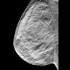 Breast Tomosynthesis Digital Social