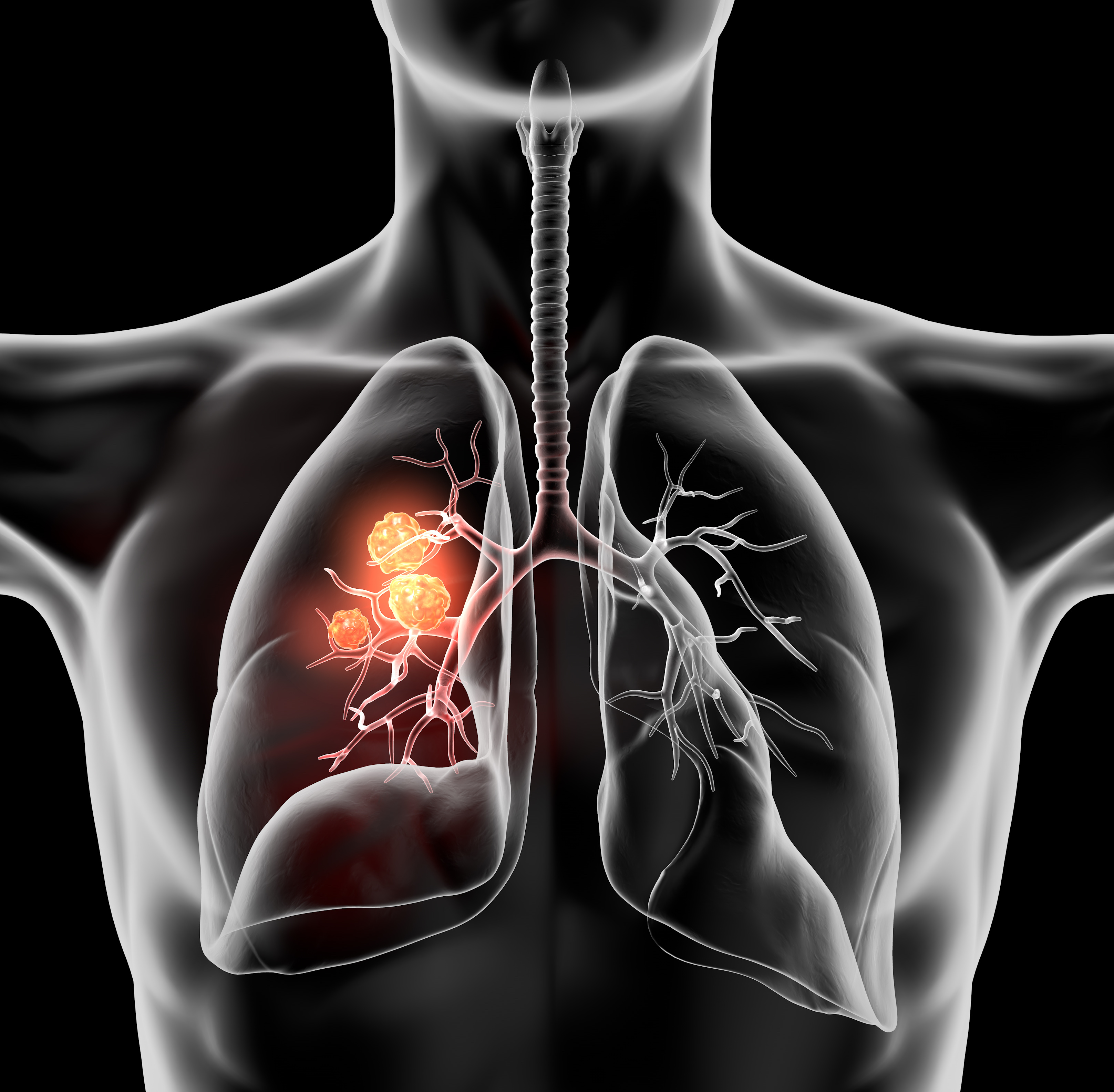 Cancer Lung 3 D Black