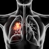 Cancer Lung 3 D Black