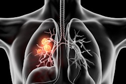 Cancer Lung 3 D Black