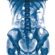 X Ray Abdomen