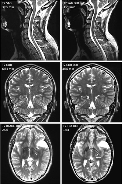 Representative artifacts frequently encountered with accelerated deep-learning reconstruction (DLR) sequences, illustrated using images from a healthy volunteer with written informed consent. (Gray arrow) Severe artifacts rendering sagittal spinal cord T2 DLR images nondiagnostic. Evaluation of the sagittal spinal cord T2 DLR images is limited by severe artifacts. (Black arrow) Linear artifacts are enhanced in coronal T2 DLR image. (White arrow) Axial brain image showing signal heterogeneity in the thalamus. In addition, there is blurring in the basal ganglia and insular region.