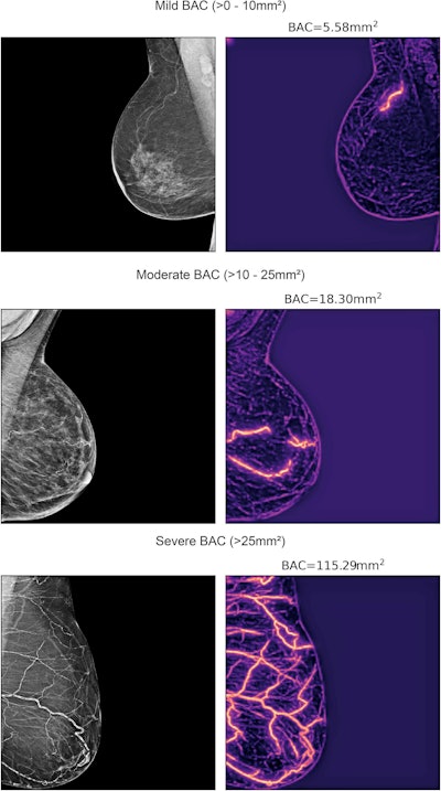 Examples of mammograms with mild, moderate, and severe breast arterial calcification quantified by an AI model developed by researchers from Emory University and Mayo Clinic Enterprise. (Left) Original image. (Right) AI model heat map with breast arterial calcification score shown above.