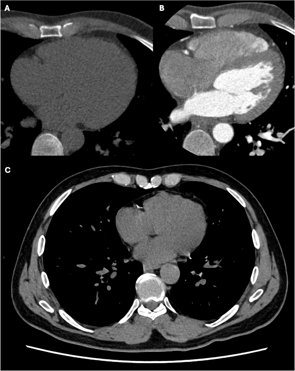 Development of CAD in a 43-year-old male smoker, with atypical chest pain, hypercholesterolemia, and a family history of CAD. At baseline, the coronary artery calcium score was zero (A), and the coronary CT angiogram was normal (B). Noncontrast CT chest (C) 10 years later showed calcified plaques in the right coronary artery and left circumflex coronary artery.