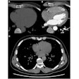 Development of CAD in a 43-year-old male smoker, with atypical chest pain, hypercholesterolemia, and a family history of CAD. At baseline, the coronary artery calcium score was zero (A), and the coronary CT angiogram was normal (B). Noncontrast CT chest (C) 10 years later showed calcified plaques in the right coronary artery and left circumflex coronary artery.