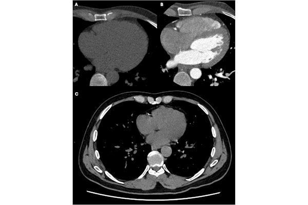 Development of CAD in a 43-year-old male smoker, with atypical chest pain, hypercholesterolemia, and a family history of CAD. At baseline, the coronary artery calcium score was zero (A), and the coronary CT angiogram was normal (B). Noncontrast CT chest (C) 10 years later showed calcified plaques in the right coronary artery and left circumflex coronary artery.