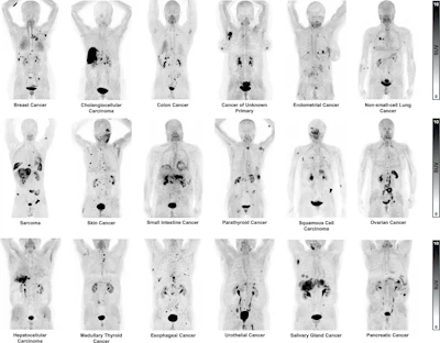 Visual comparison of maximum intensity projection images from Ga-68 BED003 PET in 18 patients with different solid malignancies.