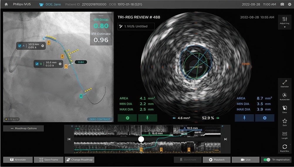 Philips IntraSight Plus screen.