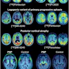 Examples of tau PET patterns in atypical AD and 4R tauopathies. Three axial slices upon MRI or MRI template show radiotracer distribution in exemplary cases of atypical AD and progressive supranuclear palsy (PSP).