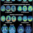 Examples of tau PET patterns in atypical AD and 4R tauopathies. Three axial slices upon MRI or MRI template show radiotracer distribution in exemplary cases of atypical AD and progressive supranuclear palsy (PSP).