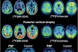 Examples of tau PET patterns in atypical AD and 4R tauopathies. Three axial slices upon MRI or MRI template show radiotracer distribution in exemplary cases of atypical AD and progressive supranuclear palsy (PSP).