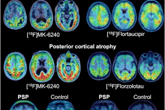Examples of tau PET patterns in atypical AD and 4R tauopathies. Three axial slices upon MRI or MRI template show radiotracer distribution in exemplary cases of atypical AD and progressive supranuclear palsy (PSP).
