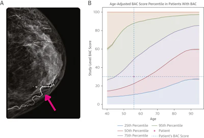 Example of Percentile Nomogram With Age-Adjusted BAC Quartiles. (A) Mammogram of a 56-year-old woman. There is evident BAC (pink arrow). This was quantified as a BAC score of 30 using the cmAngio tool. (B) Nomogram indicating that a BAC score of 30 places a 56-year-old woman within the 50th to 75th percentile for her age. Images are republished under a Creative Commons license (CC BY 4.0).