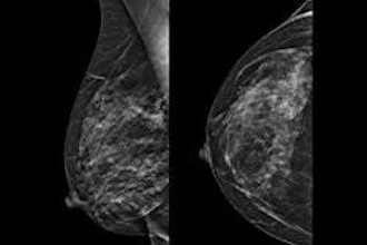Breast Image