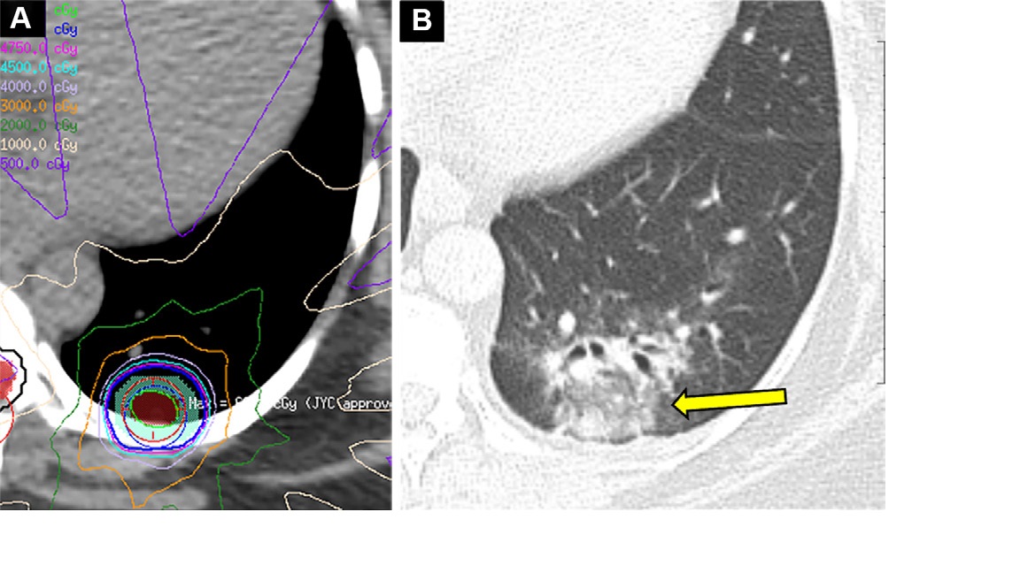 Acute radiation-induced pneumonitis after SBRT (65 Gy, four fractions) in a 53-year-old woman with leiomyosarcoma of the uterus with a left lower lobe metastasis manifesting as a small nodule (not shown). (A) Axial dosimetric reconstruction of a CT image obtained for SBRT planning shows the metastasis receiving the maximal isodose (6500 cGy). (B) Axial CT image obtained 12 months after completion of RT shows focal ground-glass and consolidative opacities confined to the treatment plan (arrow). Note that acute lung injury with SBRT typically manifests later than with conventional RT (i.e., >12 weeks after completion of therapy), and in 25% of patients, the first CT manifestations occur more than one year after completion of RT.