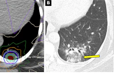 Acute radiation-induced pneumonitis after SBRT (65 Gy, four fractions) in a 53-year-old woman with leiomyosarcoma of the uterus with a left lower lobe metastasis manifesting as a small nodule (not shown). (A) Axial dosimetric reconstruction of a CT image obtained for SBRT planning shows the metastasis receiving the maximal isodose (6500 cGy). (B) Axial CT image obtained 12 months after completion of RT shows focal ground-glass and consolidative opacities confined to the treatment plan (arrow). Note that acute lung injury with SBRT typically manifests later than with conventional RT (i.e., >12 weeks after completion of therapy), and in 25% of patients, the first CT manifestations occur more than one year after completion of RT.