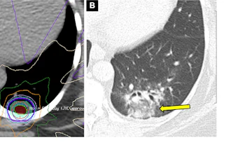 Acute radiation-induced pneumonitis after SBRT (65 Gy, four fractions) in a 53-year-old woman with leiomyosarcoma of the uterus with a left lower lobe metastasis manifesting as a small nodule (not shown). (A) Axial dosimetric reconstruction of a CT image obtained for SBRT planning shows the metastasis receiving the maximal isodose (6500 cGy). (B) Axial CT image obtained 12 months after completion of RT shows focal ground-glass and consolidative opacities confined to the treatment plan (arrow). Note that acute lung injury with SBRT typically manifests later than with conventional RT (i.e., >12 weeks after completion of therapy), and in 25% of patients, the first CT manifestations occur more than one year after completion of RT.