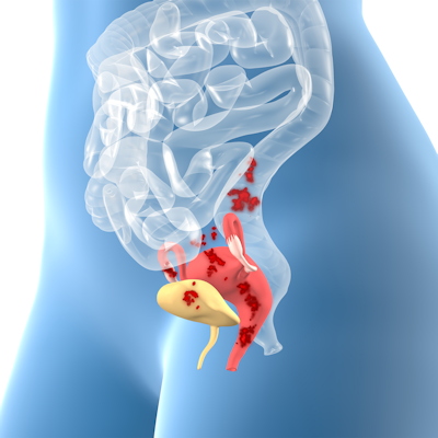 Endometriosis 3 D Illustration 400