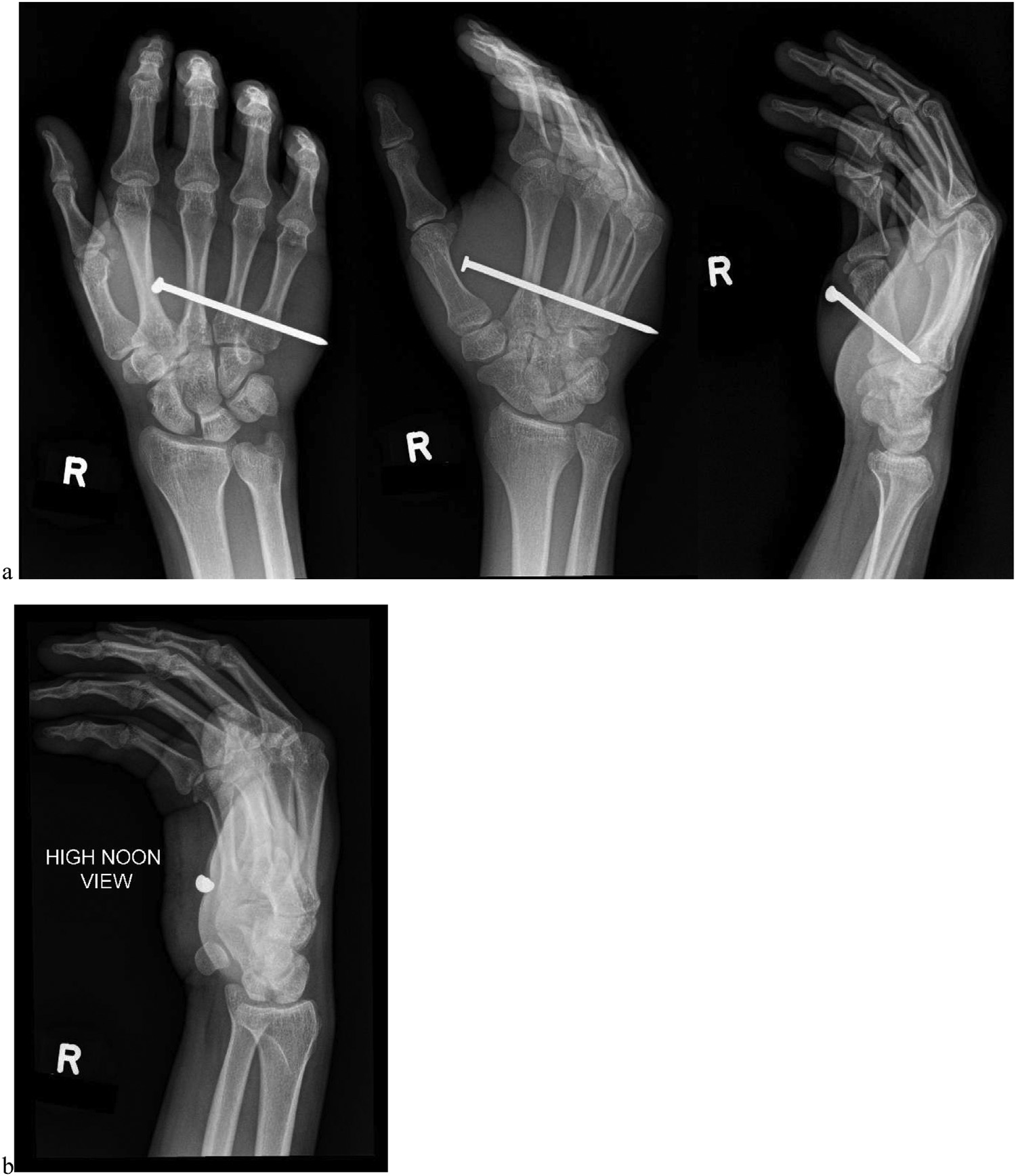 Routine hand views (a) and &lsquo;high noon&rsquo; view (b) of a 31-year-old male with penetrating nail gun injury (case 4). The lack of cortical bone involvement is much better visualized on the high noon view.