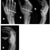 Routine hand views (a) and ‘high noon’ view (b) of a 31-year-old male with penetrating nail gun injury (case 4). The lack of cortical bone involvement is much better visualized on the high noon view.