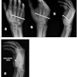 Routine hand views (a) and ‘high noon’ view (b) of a 31-year-old male with penetrating nail gun injury (case 4). The lack of cortical bone involvement is much better visualized on the high noon view.