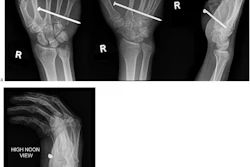 Routine hand views (a) and ‘high noon’ view (b) of a 31-year-old male with penetrating nail gun injury (case 4). The lack of cortical bone involvement is much better visualized on the high noon view.