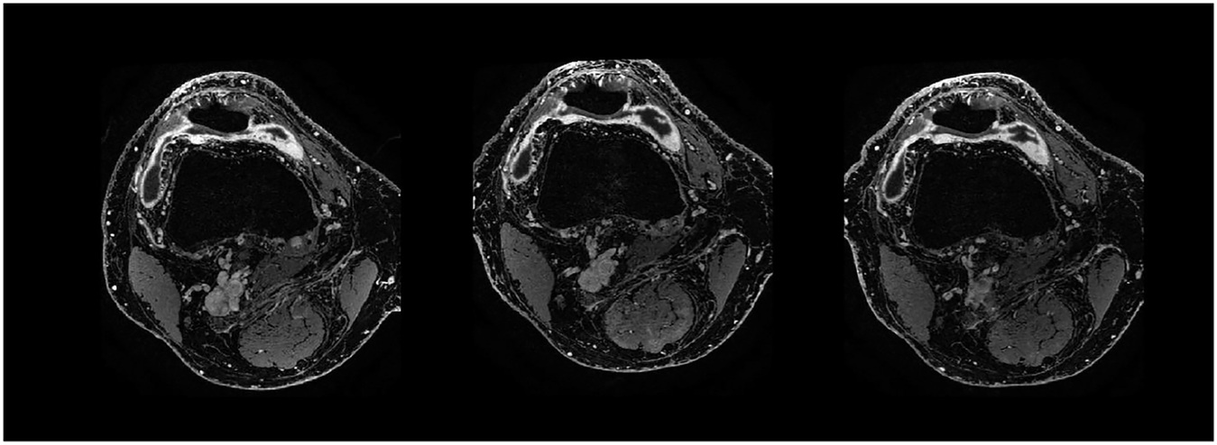 Contrast-enhanced T1 weSPGR images of the knee of a patient from the GAE group at the level of the suprapatellar recess. The baseline image (left) shows a marked synovial enhancement. There was no change one month after treatment (middle image) and four months after treatment (right image).