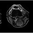 Contrast-enhanced T1 weSPGR images of the knee of a patient from the GAE group at the level of the suprapatellar recess. The baseline image (left) shows a marked synovial enhancement. There was no change one month after treatment (middle image) and four months after treatment (right image).