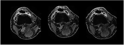 Contrast-enhanced T1 weSPGR images of the knee of a patient from the GAE group at the level of the suprapatellar recess. The baseline image (left) shows a marked synovial enhancement. There was no change one month after treatment (middle image) and four months after treatment (right image).